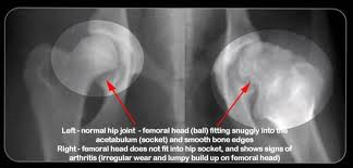 x-ray showing normal hip and a hip with dysplasia